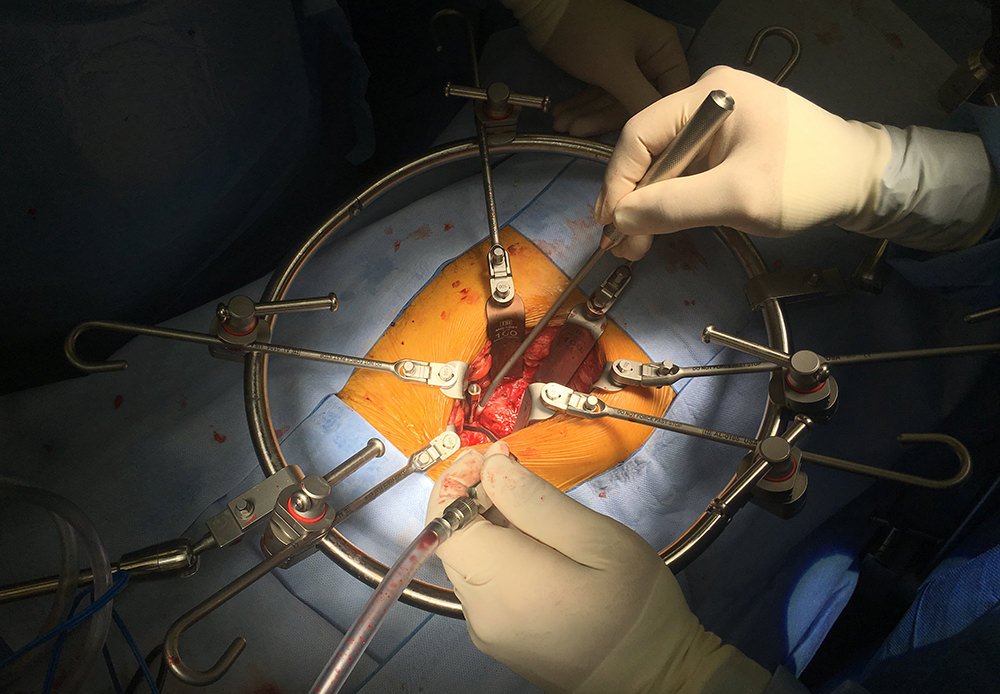 Apollo Surgical Gauze Dissectors